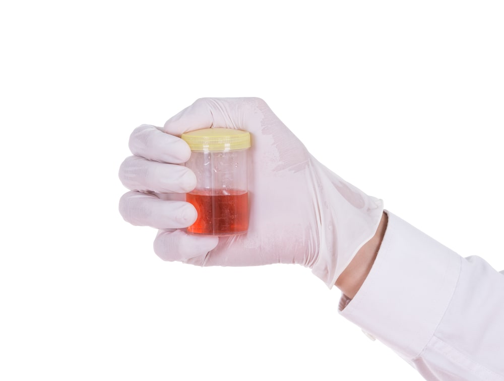 Doctor Holding Bloody Urine Sample